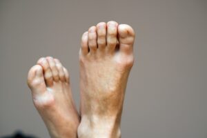 Closeup of woman feet sole with dry cracked skin. Foot and toes care concept