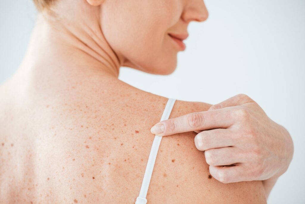 cropped view of smiling woman pointing with finger at mole on white