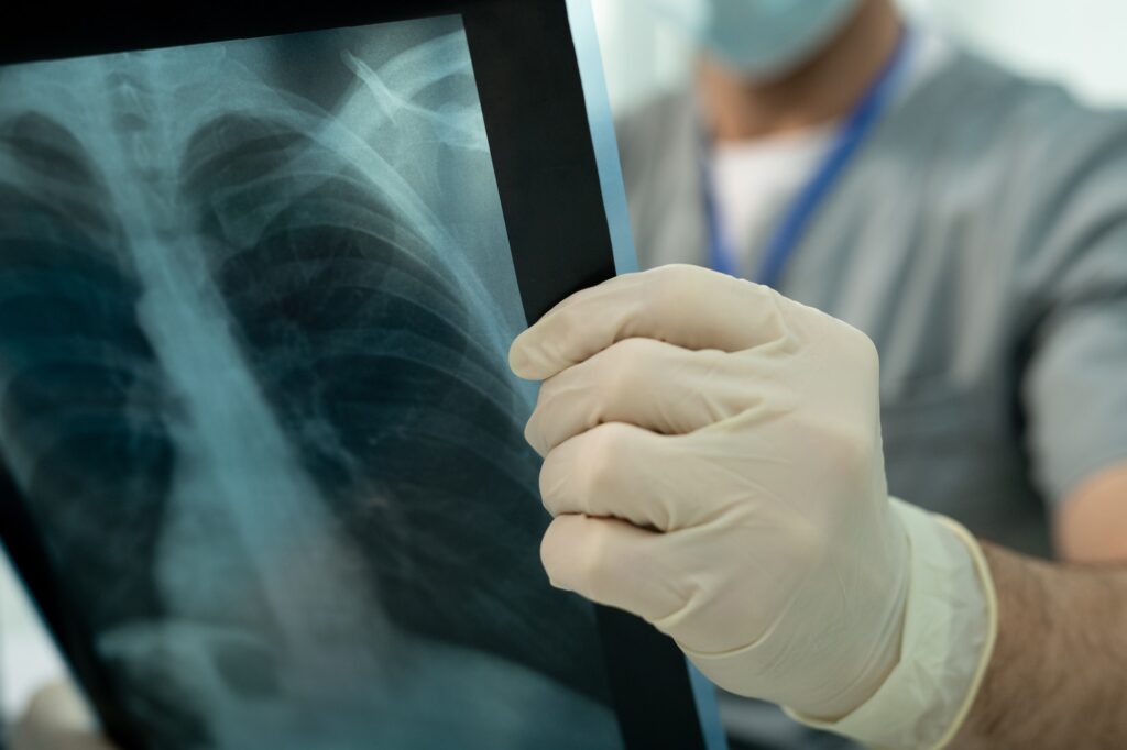 Doctor analyzing lung x-ray image