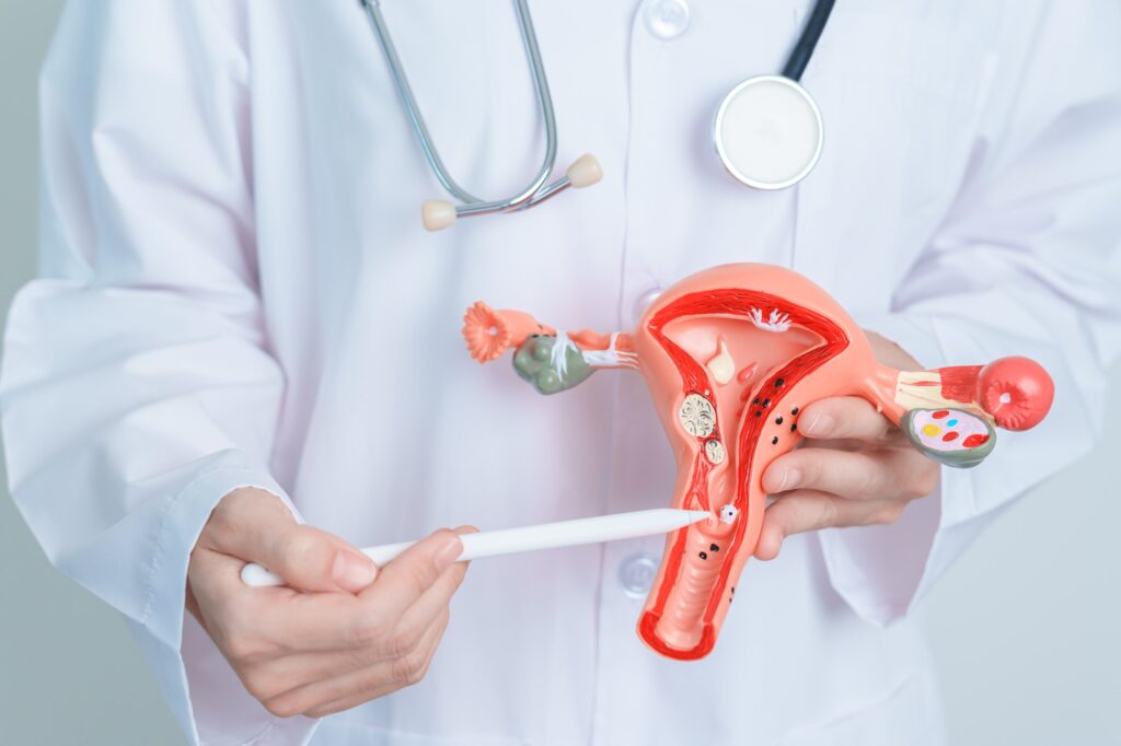 Doctor holding Uterus and Ovaries model. Ovarian and Cervical