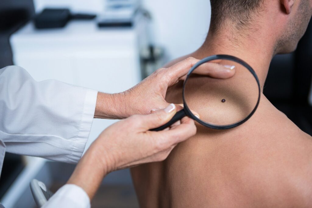 Dermatologist examining mole with magnifying glass